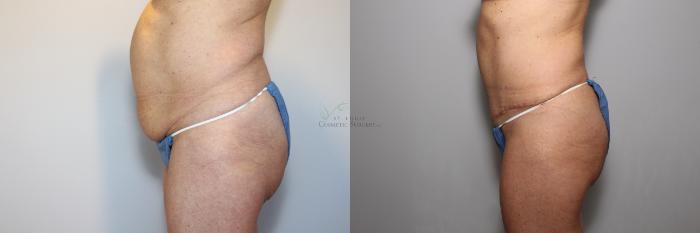 Before & After Tummy Tuck Case 88 View #3 View in St. Louis, MO