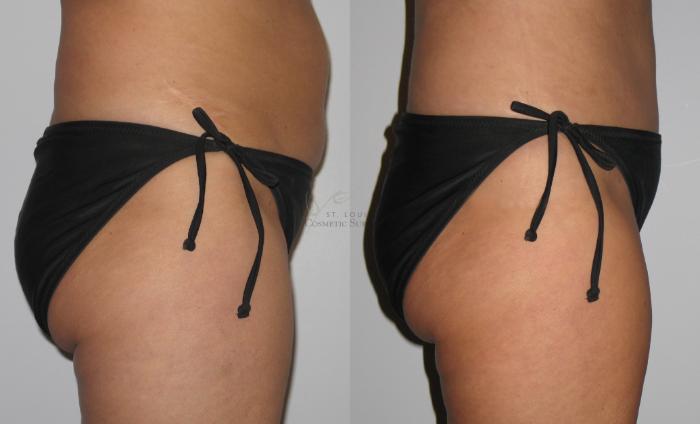 Before & After Tummy Tuck Case 9 View #1 View in St. Louis, MO