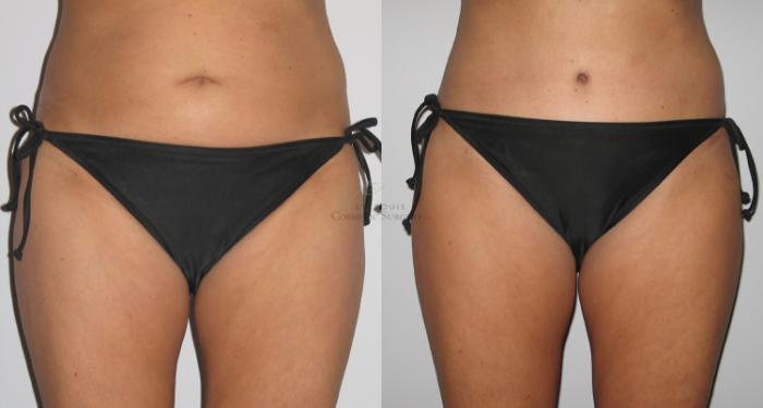 Before & After Tummy Tuck Case 9 View #2 View in St. Louis, MO
